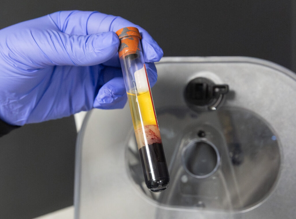 A vial of platelet-rich plasma for a PRP shot in Kansas City