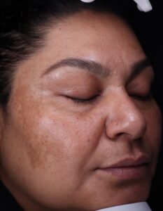 The after of BBL laser before and after in Kansas City, MO